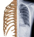 Compare CT Chest 3D rendering and Chest x-ray