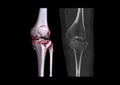 Compare of CT knee joint 3D rendering image and CT knee 2D Coronal view isolated on black background showing fracture tibia bone