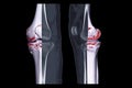 Compare of CT knee joint 3D rendering image and CT knee sagittal view and CT knee 2D Sagittal view isolated on black background