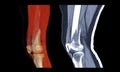 Compare of CT knee joint 3D rendering image lateral view and Sagittal view isolated on black background showing fracture Femur