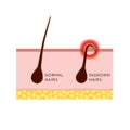 Compare ingrown and normal hair, illustration on white background