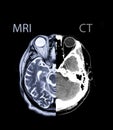 Compare and Mix MRI brain Axial T2 and Ct brain axial image.