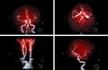 Compare of MRA Brain or Magnetic resonance angiography or MRA of cerebral artery and common carotid artery AP and Lateral View