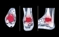 Compare of MRI ankle axial, coronal and sagittal PDW view showing bone metastasis to the talus