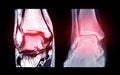 Compare MRI Ankle Coronal view and x-rai image of ankle for diagnostic tendon injury.