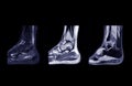 Compare of MRI Ankle Sagittal view.