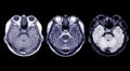 Compare MRI of the brain Axial T1, T2 and T2 Flair