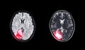 Compare MRI brain Axial T2W flair and T2W view .