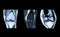 Compare of MRI Knee joint or Magnetic resonance imaging coronal view. Royalty Free Stock Photo
