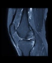Compare of MRI knee or Magnetic resonance imaging of knee joint stir technique of axial, sagittal and coronal view for fat