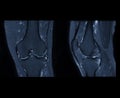 Compare of MRI knee or Magnetic resonance imaging of knee joint stir technique of axial, sagittal and coronal view for fat