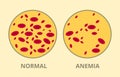 Compare between normal blood cell vs anemia disease sick