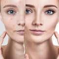 Compare of old photo with acne and healthy skin.