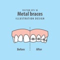 Compare upper teeth Metal braces before and after illustration vector on blue background. Dental concept
