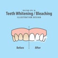 Compare upper teeth Whitening-Bleaching before and after illustration vector on blue background. Dental concept. Royalty Free Stock Photo