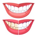 Comparing teeth with plaque, healthy hygiene white