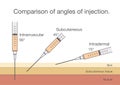 Comparison of the angles of intramuscular injection. Royalty Free Stock Photo