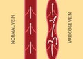Comparison compare between normal vein and varicose vein in vertical alignment