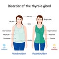 Comparison and difference between Hyperthyroidism and Hypothyroidism Royalty Free Stock Photo