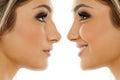 Rhinoplasty