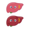 Comparison of healthy liver and fatty live,