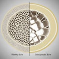 Comparison of Healthy and Osteoporotic Bone Structure Royalty Free Stock Photo