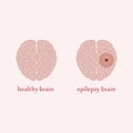 Epilepsy brain Royalty Free Stock Photo