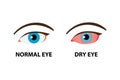 Comparison illustration between normal and dry eye Royalty Free Stock Photo