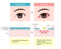 Comparison illustration between normal and dry eye. Cross section of eye surface Royalty Free Stock Photo