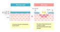 Comparison illustration between normal and dry eye. Cross section of eye surface Royalty Free Stock Photo