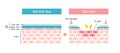 Comparison illustration between normal and dry eye. Cross section of eye surface Royalty Free Stock Photo