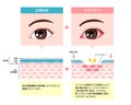 Comparison illustration between normal and dry eye. Cross section of eye surface. Japanese Royalty Free Stock Photo