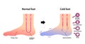 Comparison illustration of normal foot and cold foot sensitivity to cold, cold toes