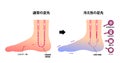 Comparison illustration of normal foot and cold foot sensitivity to cold, cold toes / Japanese