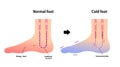 Comparison illustration of normal foot and cold foot sensitivity to cold, cold toes