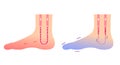 Comparison illustration of normal foot and cold foot sensitivity to cold, cold toes / no text