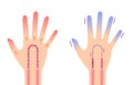 Comparison illustration of normal hand and cold hand sensitivity to cold, cold fingertips / no text