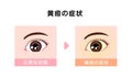 Comparison illustration of normal and jaundiced eyes