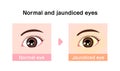 Comparison illustration of normal and jaundiced eyes