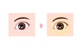 Comparison illustration of normal and jaundiced eyes