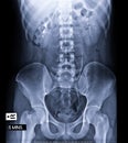 Comparison of Intravenous pyelogram or I.V.P