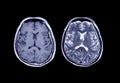 MRI brain Axial T1 and T2.