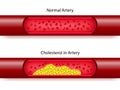 Comparison between normal artery and cholesterol Royalty Free Stock Photo