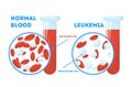 Comparison between normal blood and leukemia. Dangerous