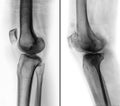 Comparison between normal human knee & x28; left image & x29; and osteoarthritis knee & x28; right image & x29; . Lateral view