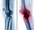 Comparison between normal human knee & x28; left image & x29; and osteoarthritis knee & x28; right image & x29; . Lateral view