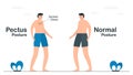 Comparison of normal and pectus posture. Pectus excavatum has a sunken chest. Pulmonology vector illustration about restrictive Royalty Free Stock Photo