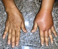 Comparison of normal right hand to Left Swollen and red hand caused by allergic reaction after insect bite in adult female patient