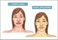 The Comparison between normal skin people and yellowing from Jaundice Royalty Free Stock Photo