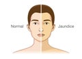 The Comparison between normal skin people and yellowing from Jaundice.